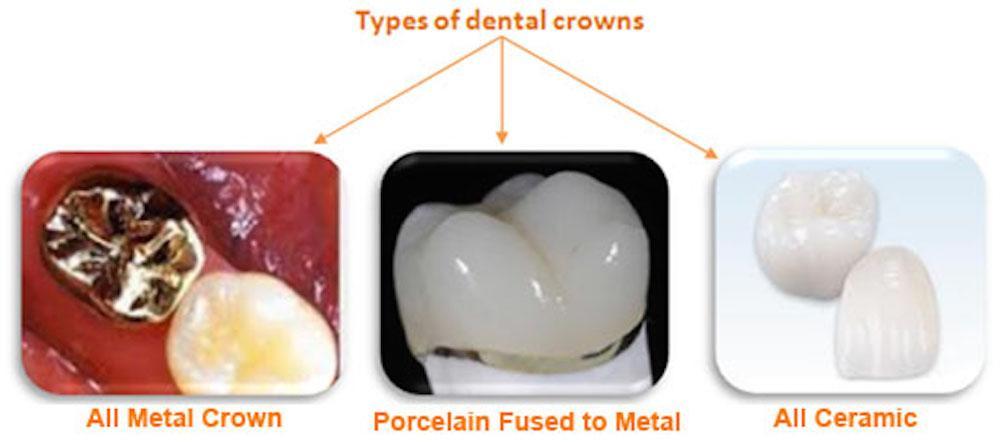 Crowns & Bridges in Hoodi