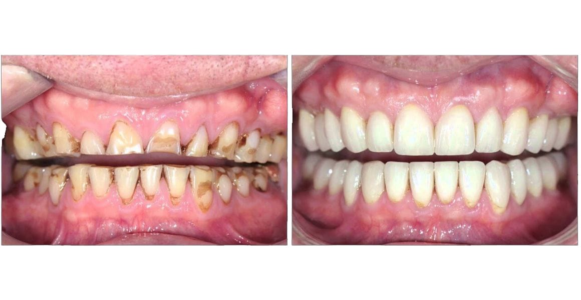 Full Mouth Rehabilitation in Hoodi