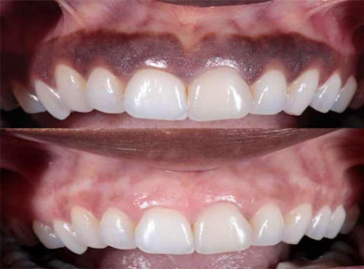 Gum Depigmentation in Whitefield