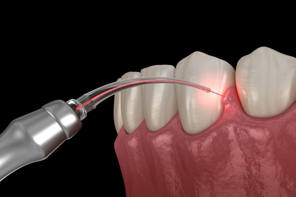 Laser Dentistry in Ramamurthy Nagar