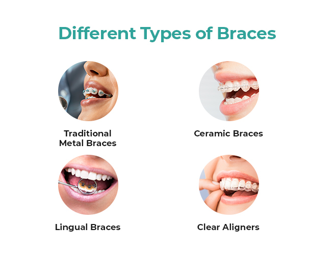 Braces / Orthodontic treatment in Ramamurthy Nagar