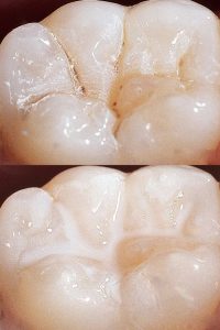 Pit and Fissure Sealants in Hoodi