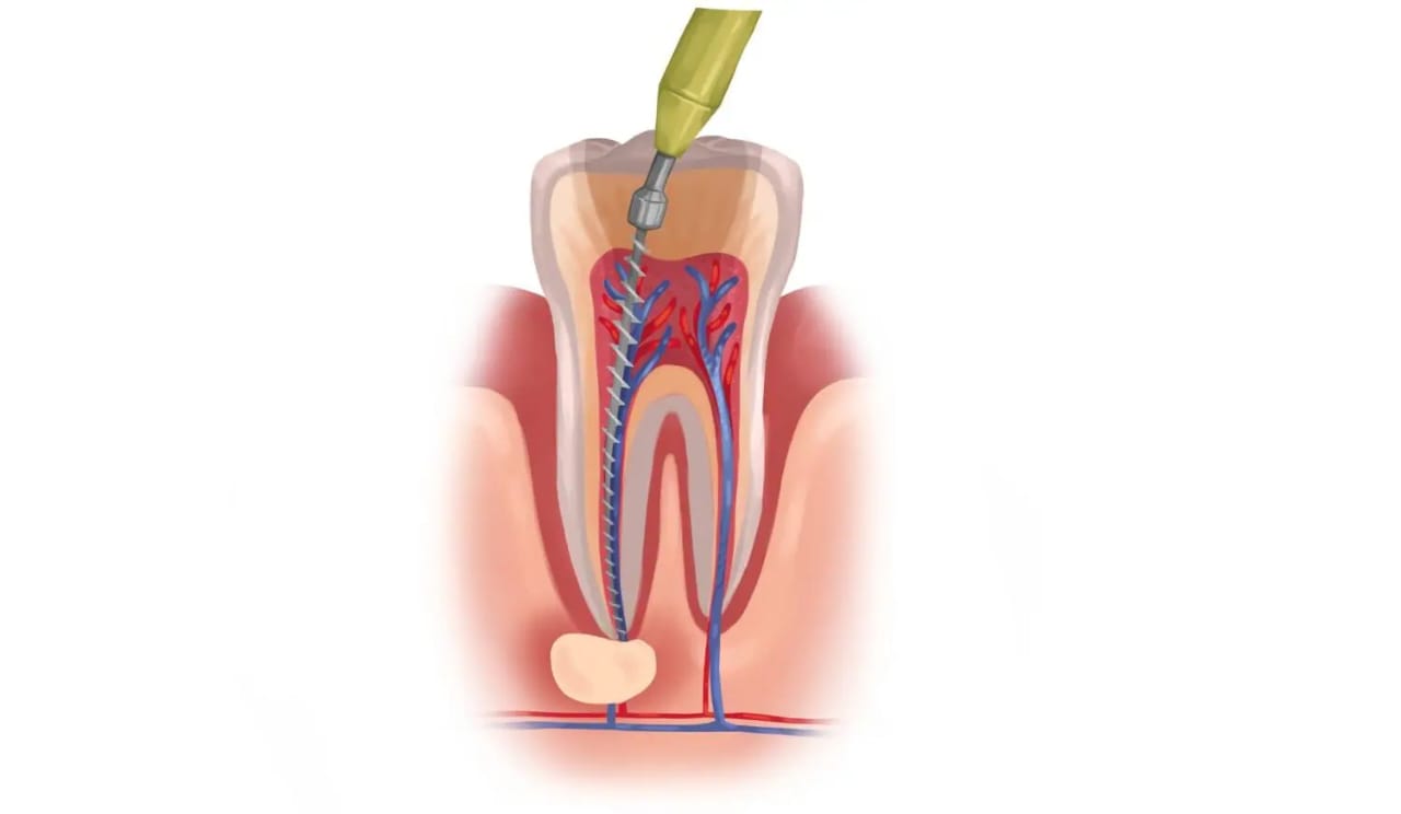 Root Canal treatment in KR Puram