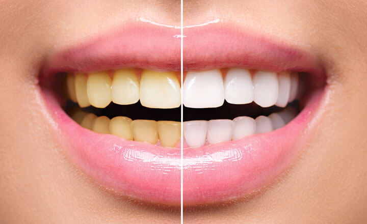 Teeth Whitening in Ramamurthy Nagar