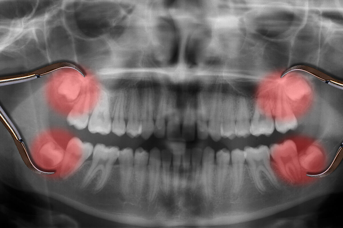 Wisdom Teeth Removal in Whitefield